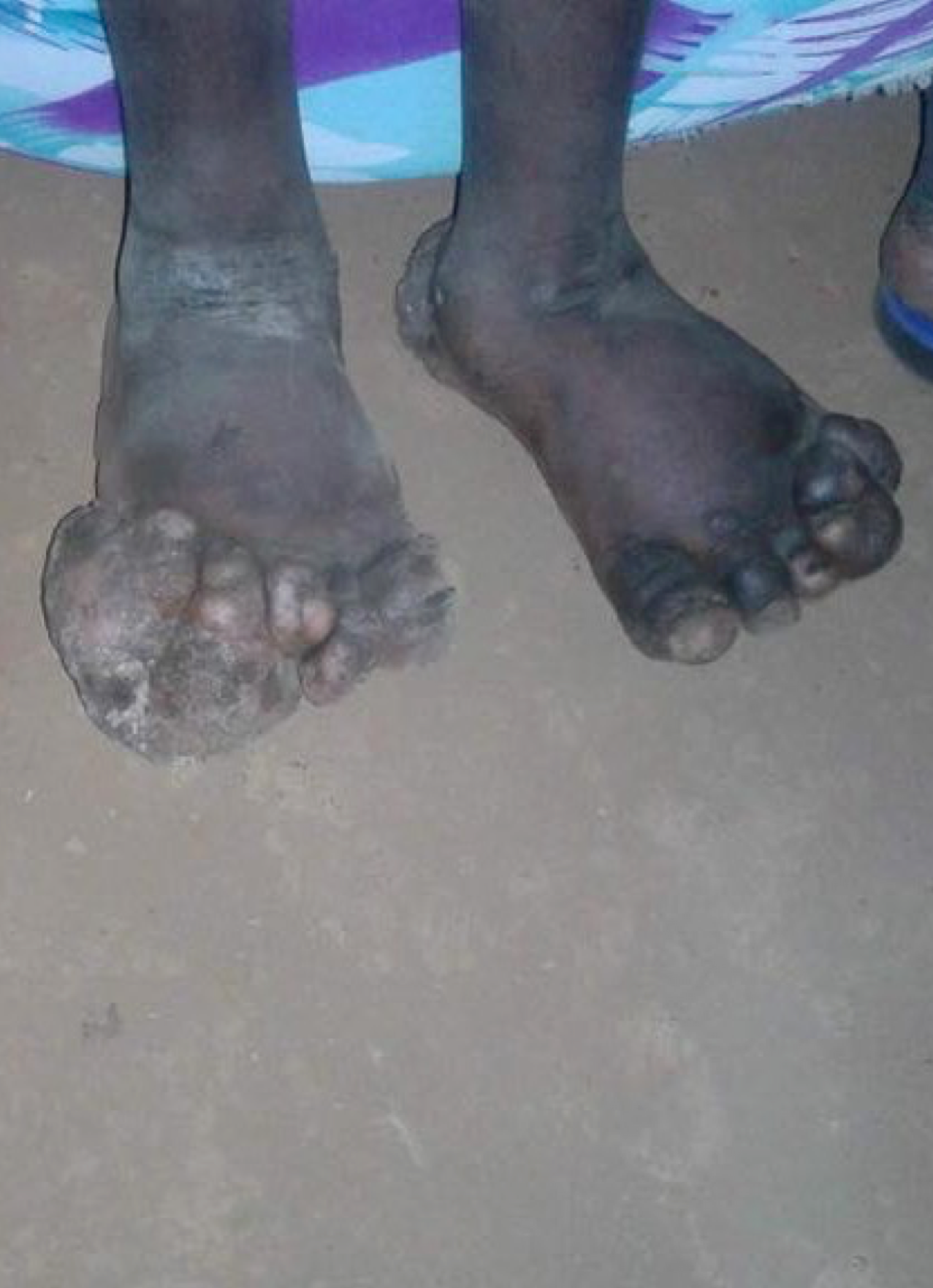 sores feet foot shoes shoe help project home of hope homeofhope brian thomson rwanda kenya congo drc africa sponsor sponsorship donate donation