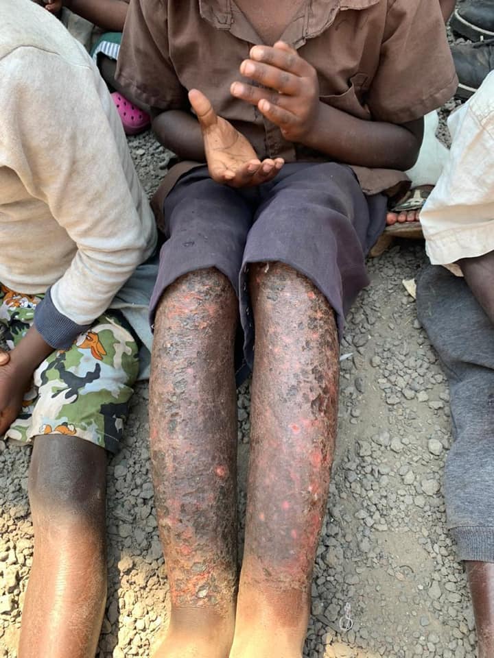 malnourished child's legs
